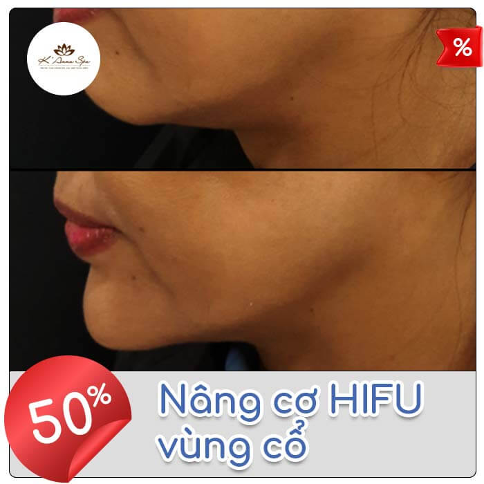 Nâng cơ HIFU vùng cổ